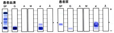 M蛋白（IgGκ、BJPκ）症例